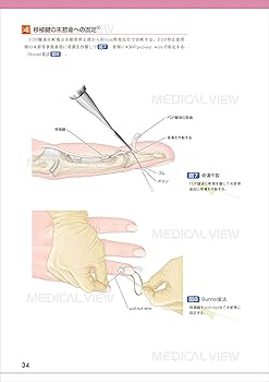 手・手関節の骨折・外傷の手術 (OS NEXUS(電子版付き) 3) | 岩崎 倫政