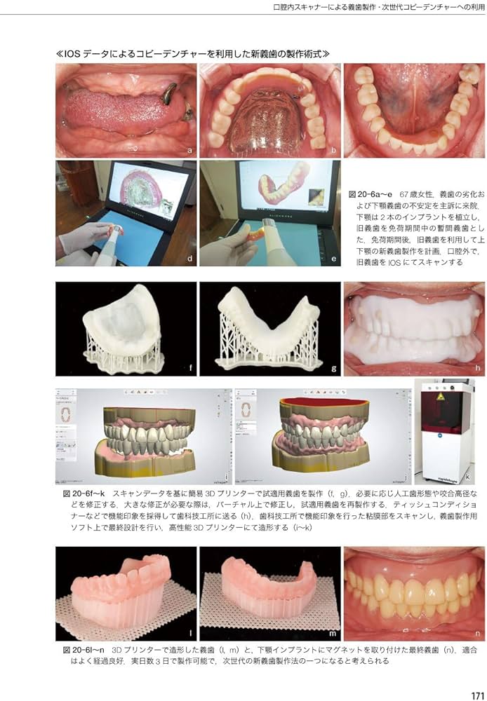 新インプラントオーバーデンチャーの基本と臨床 磁性アタッチメントを