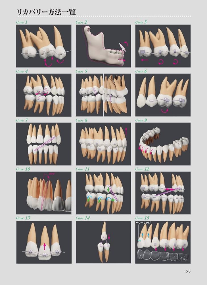 Amazon.co.jp: アライナー矯正のリカバリーテクニック : 槇 宏太郎, 槇