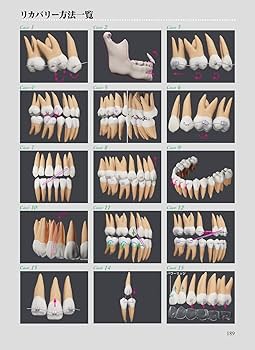 Amazon.co.jp: アライナー矯正のリカバリーテクニック : 槇 宏太郎, 槇