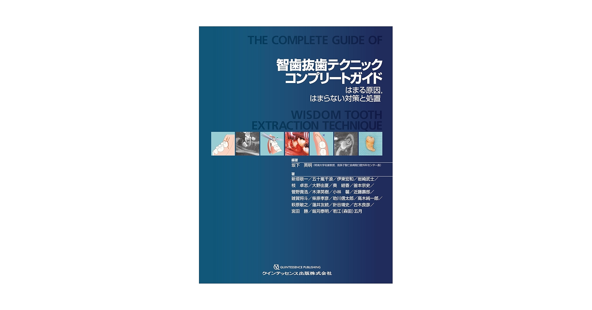 Amazon.co.jp: 智歯抜歯テクニックコンプリートガイド: はまる原因