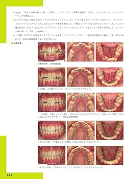 リンガルブランケット矯正の臨床 | 居波 徹, 佐奈 正敏, 相澤 一郎, 椿