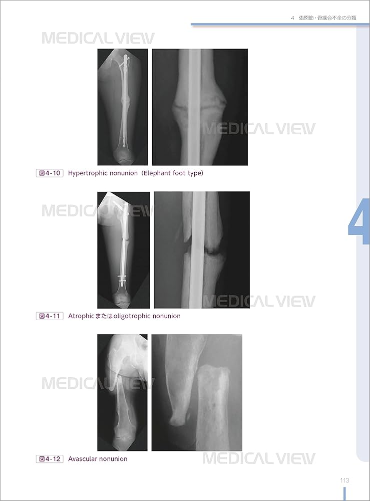 白熱講義 骨折合併症 Nonunion, Malunion, FRI, PTOA−骨折治療の物理