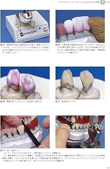 歯冠修復治療のテクニカルリクワイヤメント: 歯冠修復物製作のための
