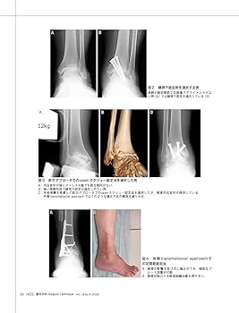 整形外科サージカルテクニック 2024年4号〈特集〉変形性足関節症の手術