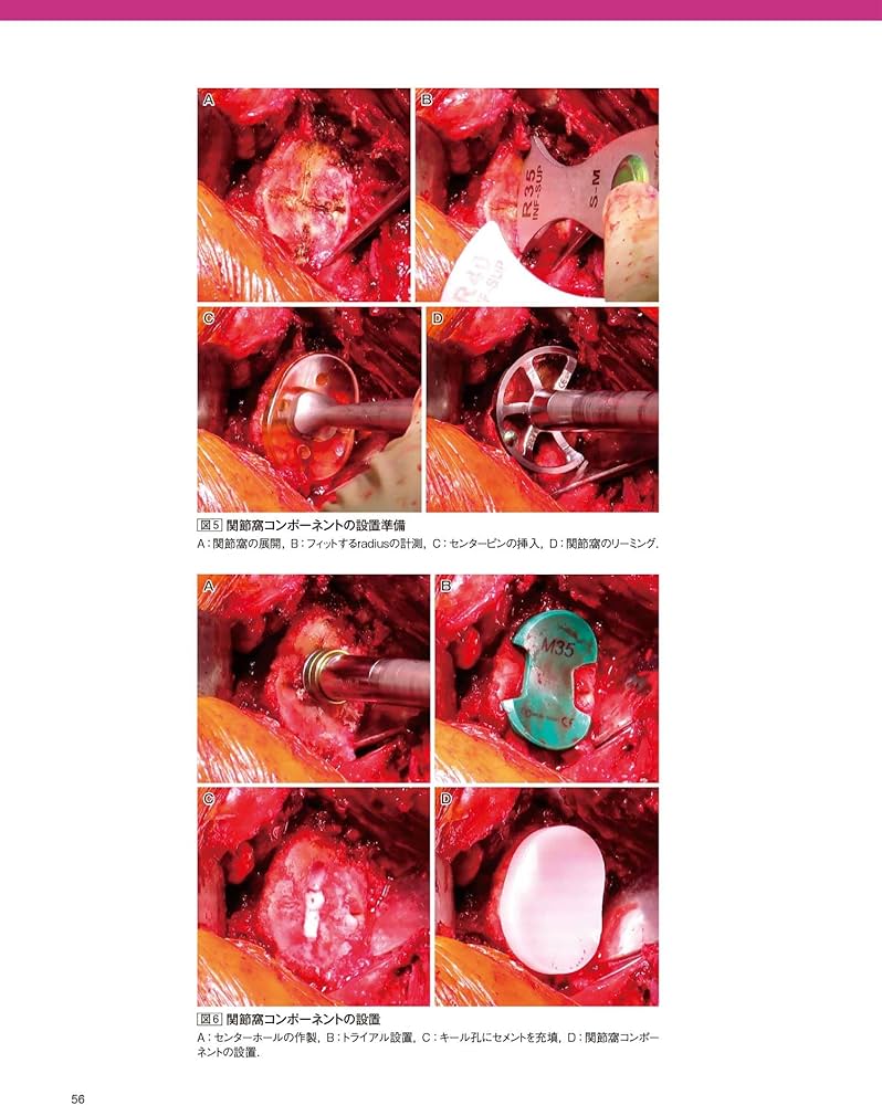 人工肩関節置換術: HHR・TSA・RSA (整形外科SURGICAL TECHNIQUE BOOKS