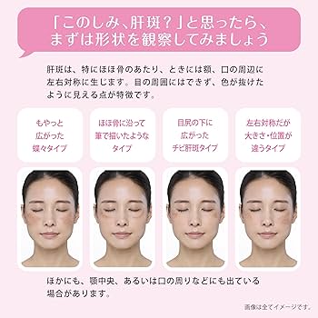 Amazon.co.jp: 【第1類医薬品】トランシーノEX 240錠 : ドラッグストア