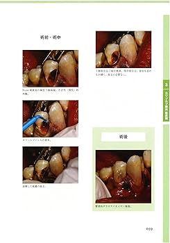 カリソルブ療法とペリソルブ療法の基礎と臨床、応用まで: スウェーデン