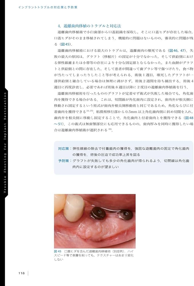 インプラントトラブルの対応策と予防策 | 鈴木 貴規 |本 | 通販 | Amazon