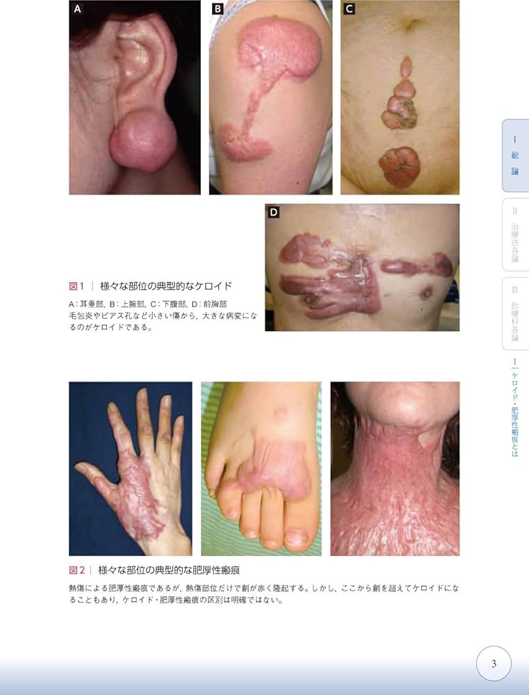 Amazon.co.jp: ここまでできる ケロイド・肥厚性瘢痕の予防と治療