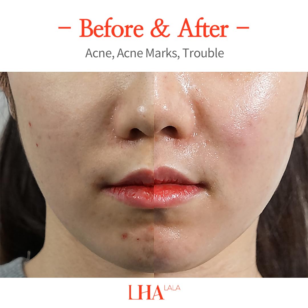 Amazon.com: [LHALALA Official] LHALA Peel Set (Basic + Ultra