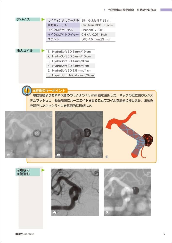 未破裂脳動脈瘤コイル塞栓術100のテクニック | 大石 英則 |本 | 通販