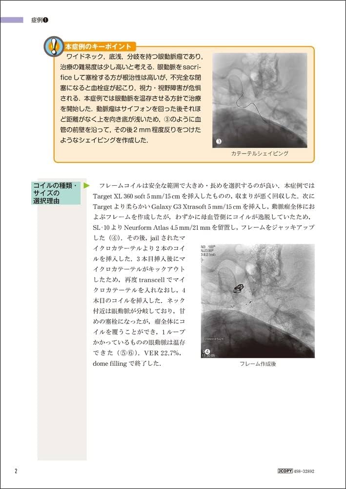 未破裂脳動脈瘤コイル塞栓術100のテクニック | 大石 英則 |本 | 通販