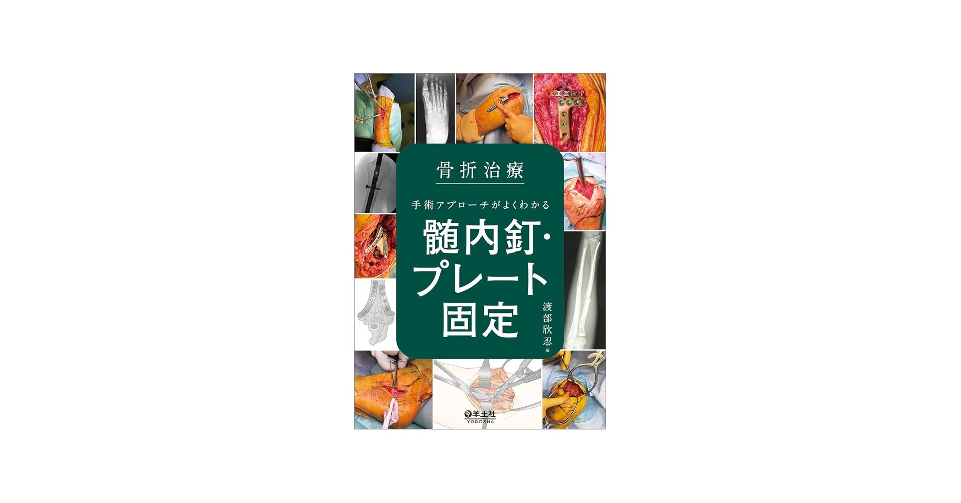 骨折治療 手術アプローチがよくわかる髄内釘・プレート固定 | 渡部 欣