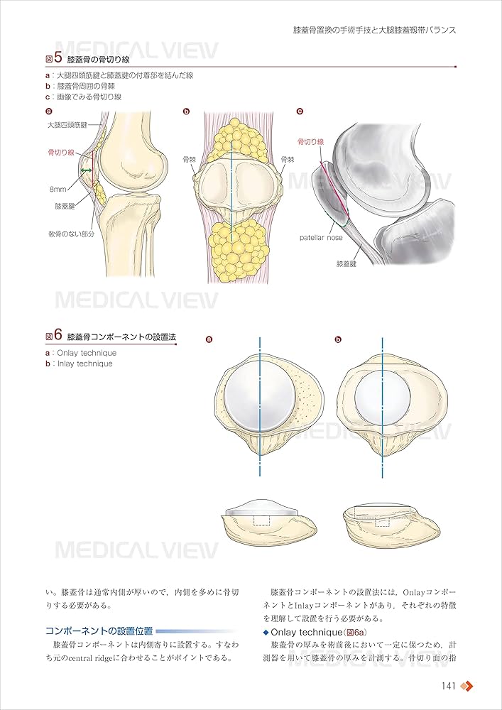 人工膝関節全置換術[TKA]のすべて−より安全に・より確実に | 勝呂 徹