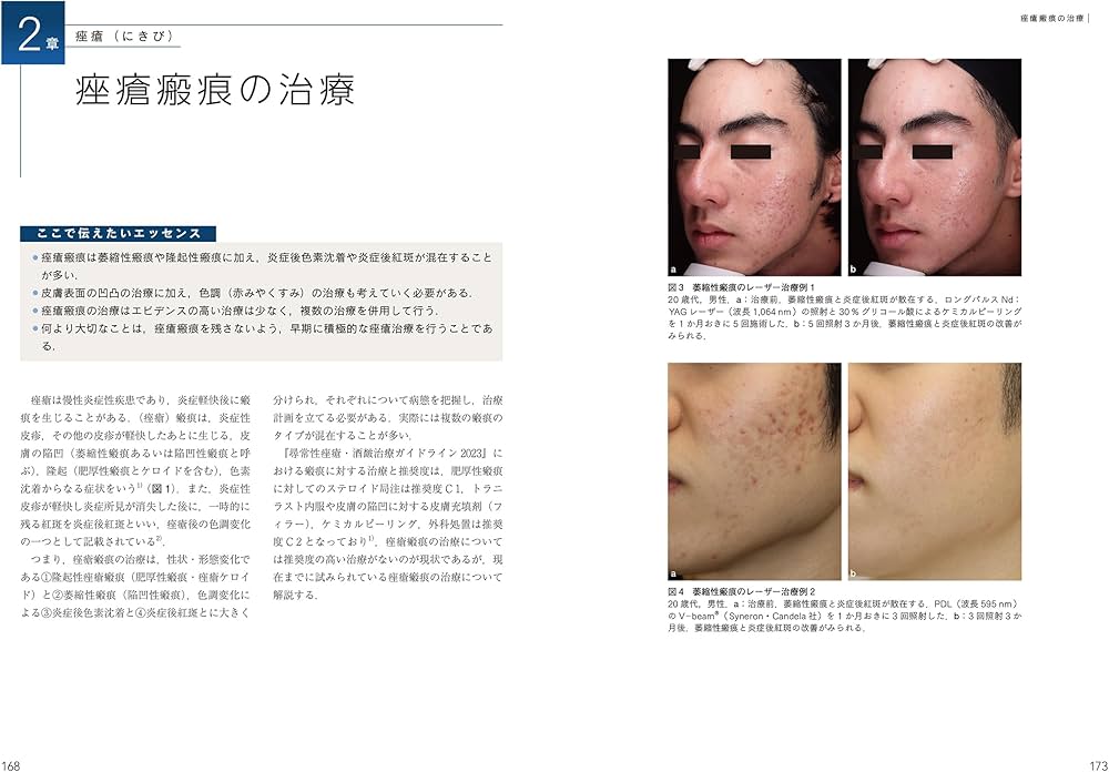 脱毛・にきびの治療ー美容皮膚科オールラウンド (最新美容皮膚科学大系