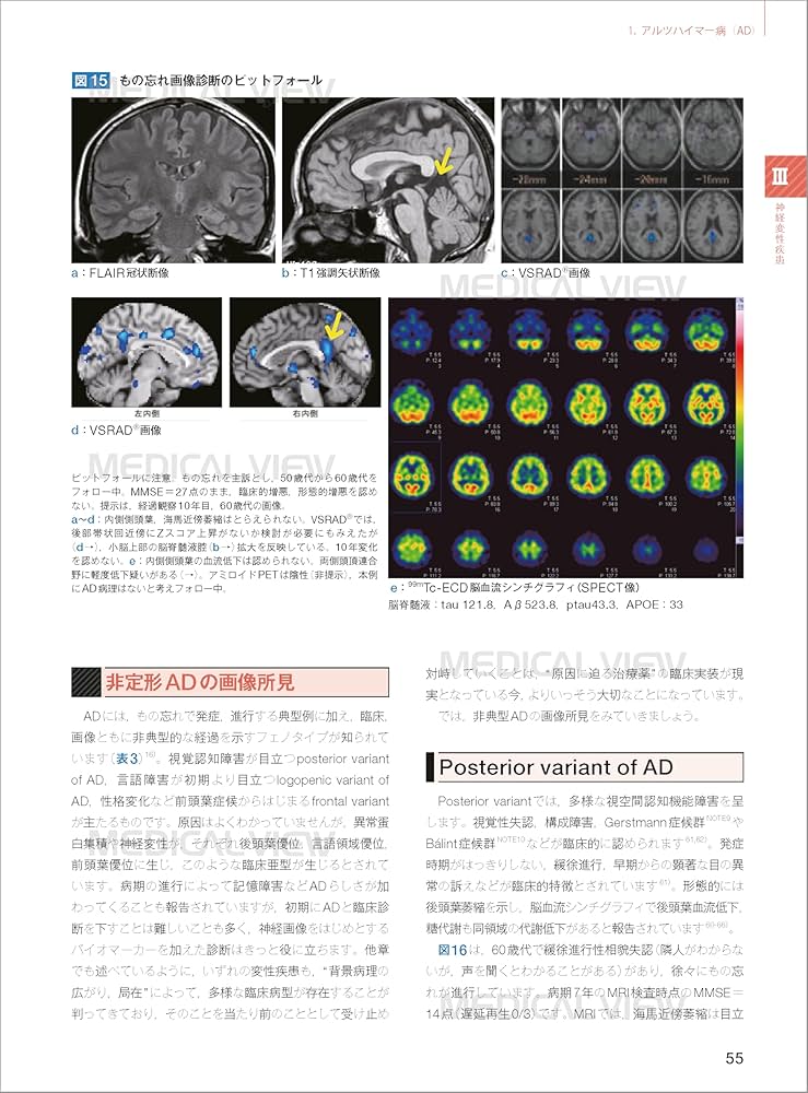 画像で究める認知症 | 德丸 阿耶 |本 | 通販 | Amazon