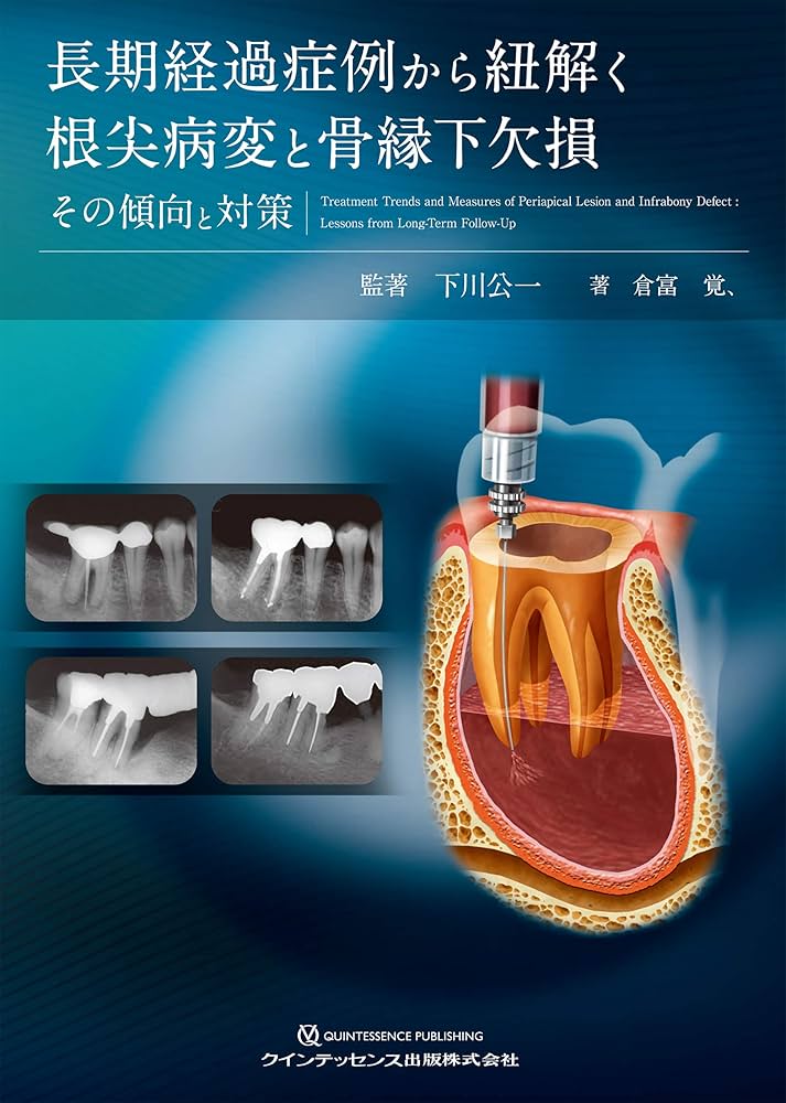 長期経過症例から紐解く根尖病変と骨縁下欠損 | 下川 公一, 倉富 覚