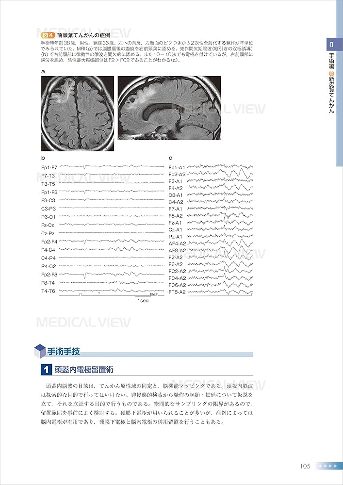 脳波判読の基礎と手術への応用−脳波ギライを克服しよう! (新NS NOW 7