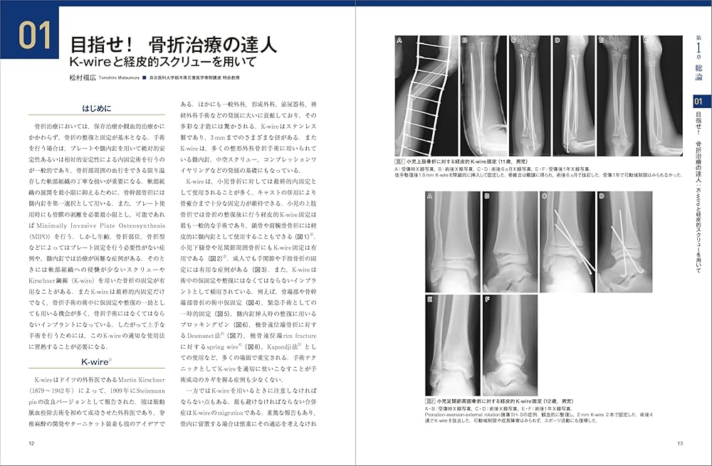 骨折のピンニングと経皮的スクリュー固定： 経皮テクニック完全攻略