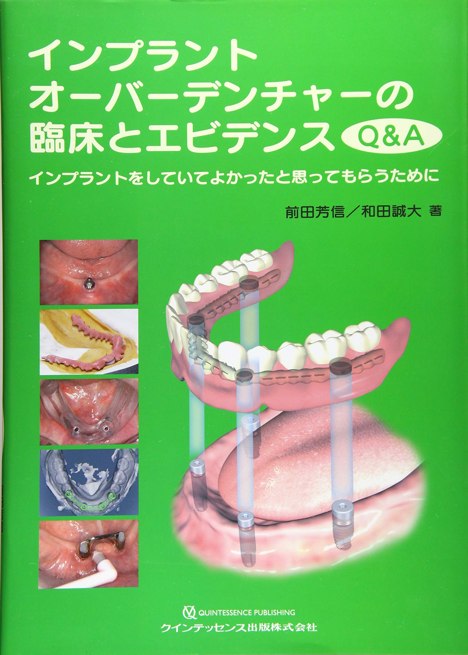 インプラントオーバーデンチャーの臨床とエビデンスQ&A (―インプラント