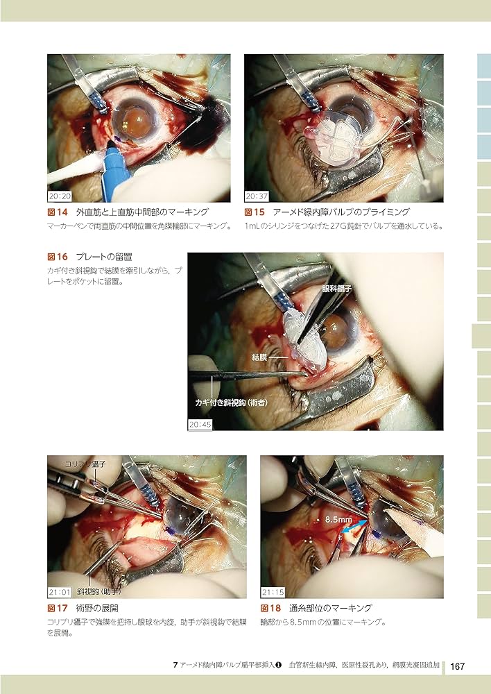 緑内障ロングチューブシャント手術実践マニュアル | 谷戸 正樹 |本