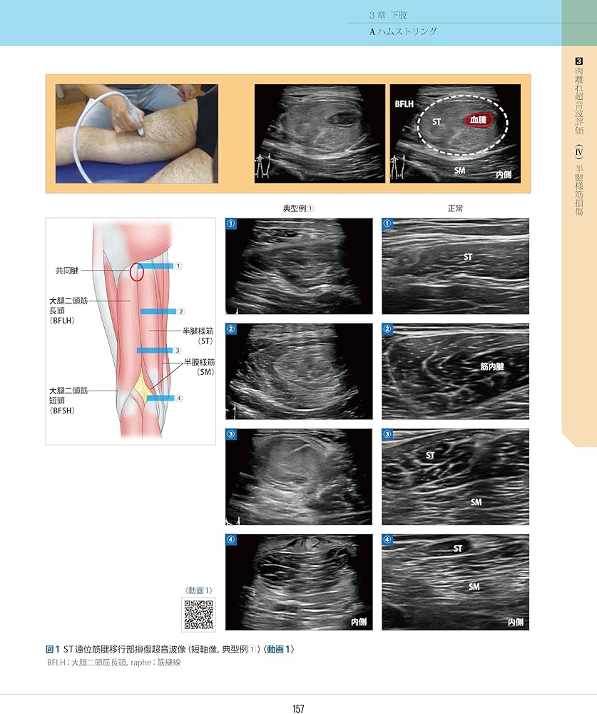 スポーツ障害〉筋損傷のエコー活用術 ―電子版付― | 和田 誠, 熊井 司