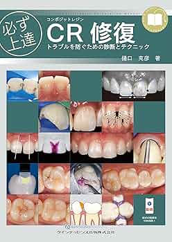 必ず上達 CR(コンポジットレジン)修復: トラブルを防ぐための診断と