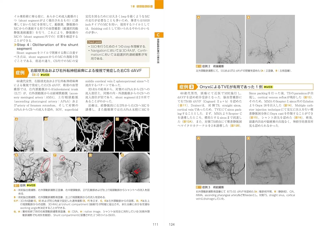 dAVF・AVM（硬膜動静脈瘻・脳動静脈奇形）のすべて：中枢神経系