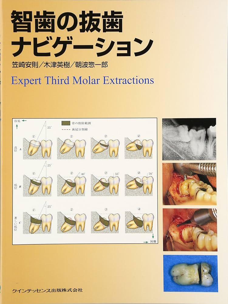 智歯の抜歯ナビゲ-ション | 笠崎 安則 |本 | 通販 | Amazon