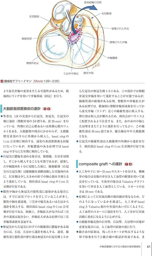 弁膜症の手術 (心臓血管外科手術エクセレンス) | 高梨 秀一郎, 坂東 興