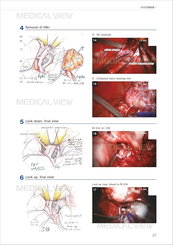 エッセンシャル頭蓋底外科−イラストとビデオで学ぶ頭蓋底中心部腫瘍の