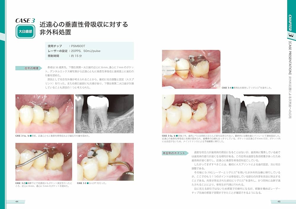 Amazon.co.jp: Er:YAGレーザーとFGF-2による低侵襲再生療法 : 原田