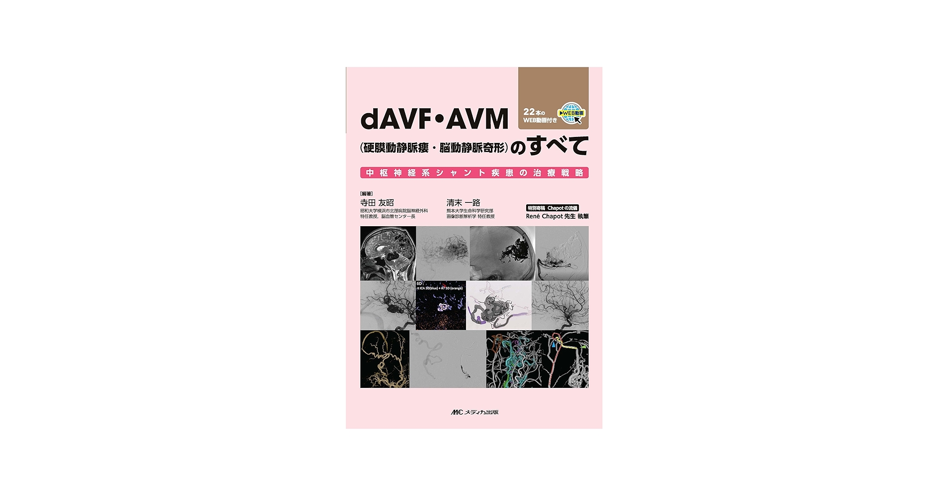 dAVF・AVM（硬膜動静脈瘻・脳動静脈奇形）のすべて：中枢神経系