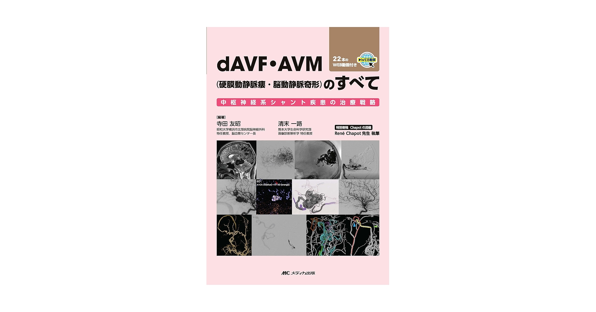裁断済】dAVF・AVM (脳動静脈奇形) のすべて dAVF・AVM（硬膜動静脈