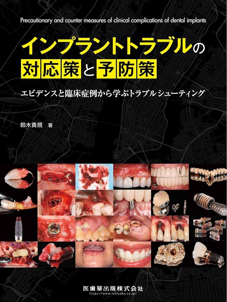 インプラントトラブルの対応策と予防策 | 鈴木 貴規 |本 | 通販 | Amazon