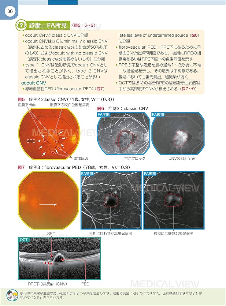 網膜診療クローズアップ 改訂第2版 | 柳 靖雄 |本 | 通販 | Amazon