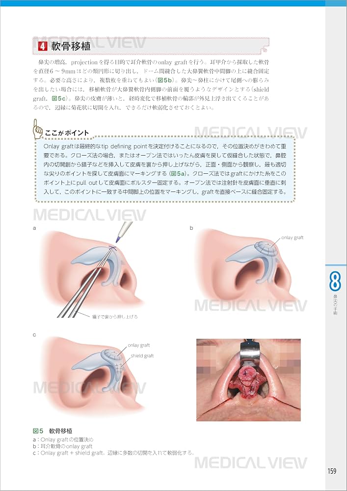 外鼻形成術−機能と形態を両立した手術 | ライノプラスティー研究会