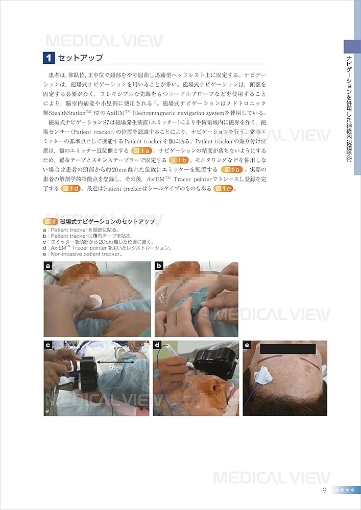 Advanced神経内視鏡手術−神経内視鏡の可能性をさらに拡げる (新NS NOW