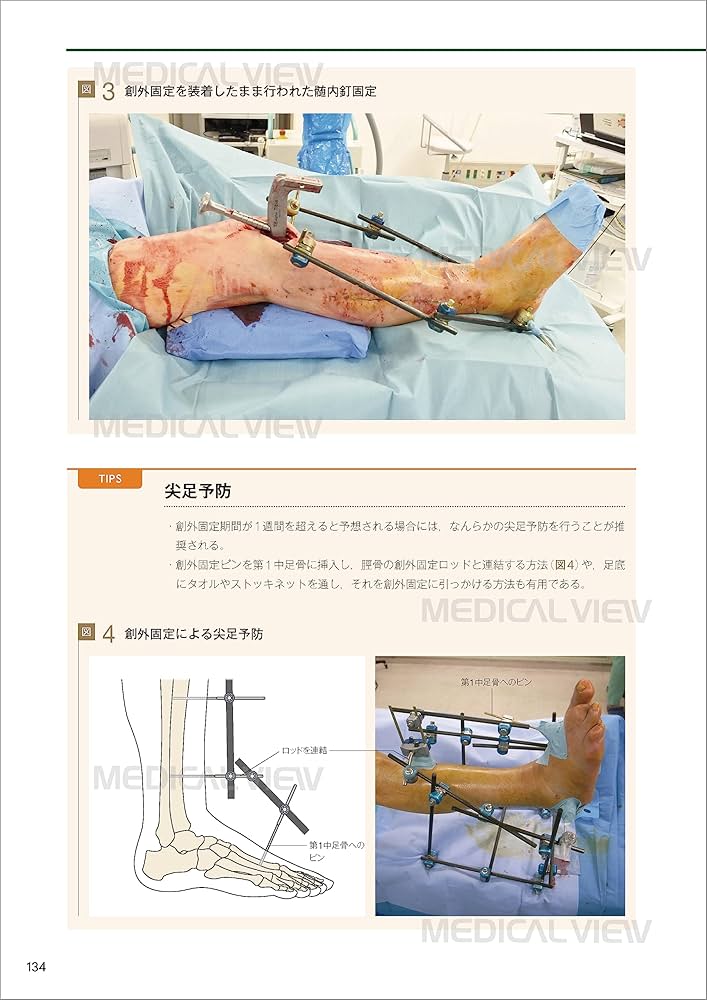 一時的創外固定マニュアル | 日本四肢再建・創外固定学会 |本 | 通販