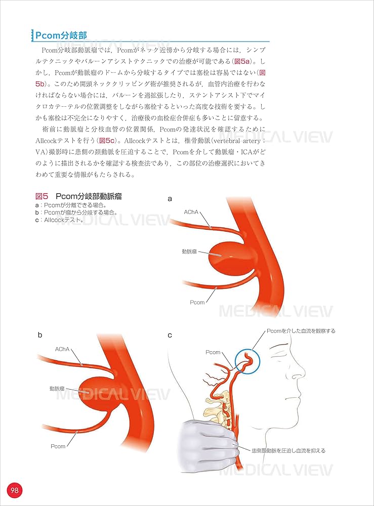 脳血管内治療 スタート&スタンダード | 吉村 紳一 |本 | 通販 | Amazon