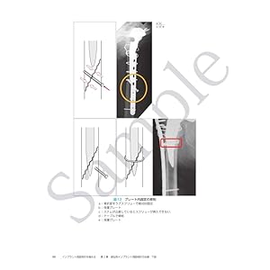 インプラント周囲骨折を極める | 馬場智規 |本 | 通販 | Amazon
