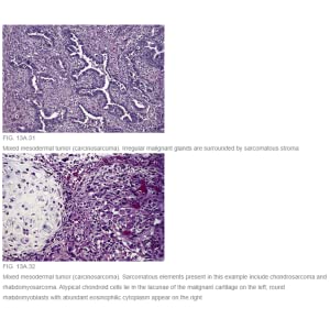 Diagnostic Histopathology of Tumors, 2 Volume Set: Expert Consult
