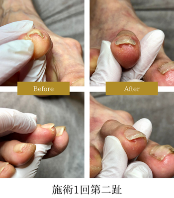 ペディグラス巻き爪補正スクール | 神戸の巻き爪治療専門店｜神戸足の