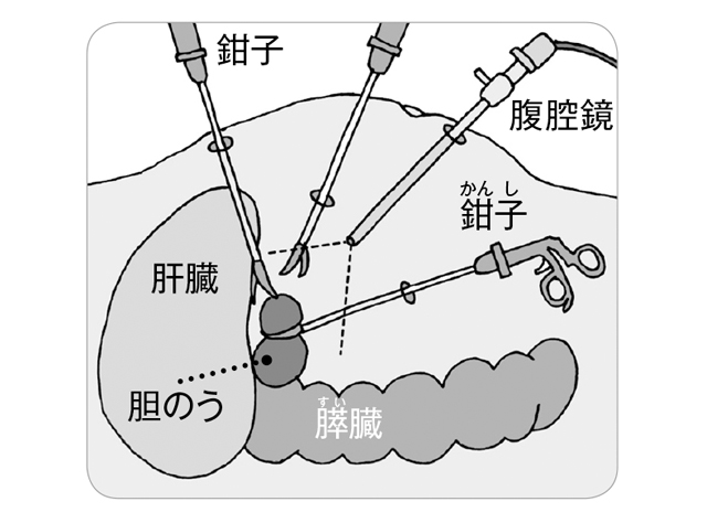 発症72時間以内の手術が最善！「胆石」の治療法とは？ | 毎日が発見ネット