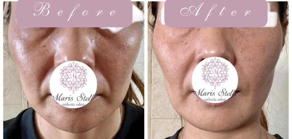 クロニクルコンセントレイトパック詳細 - マリチュード