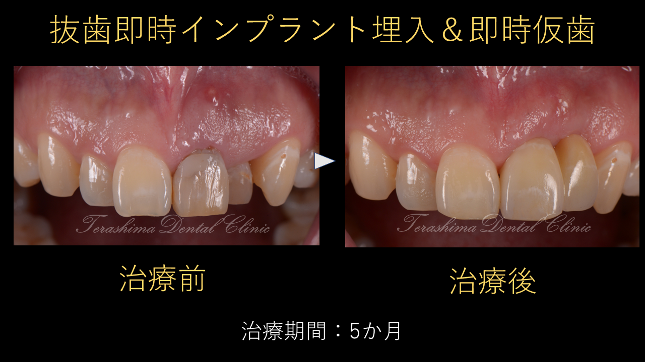 前歯のインプラントは本当に難しい～36歳男性 抜歯即時埋入 歯肉移植