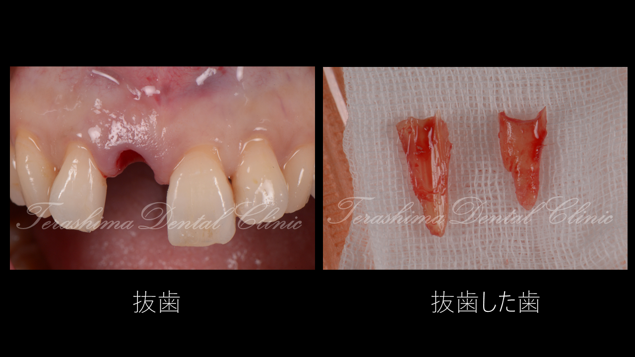 前歯のインプラント治療~やっぱり前歯部は難しい～ | 箕面市の歯医者