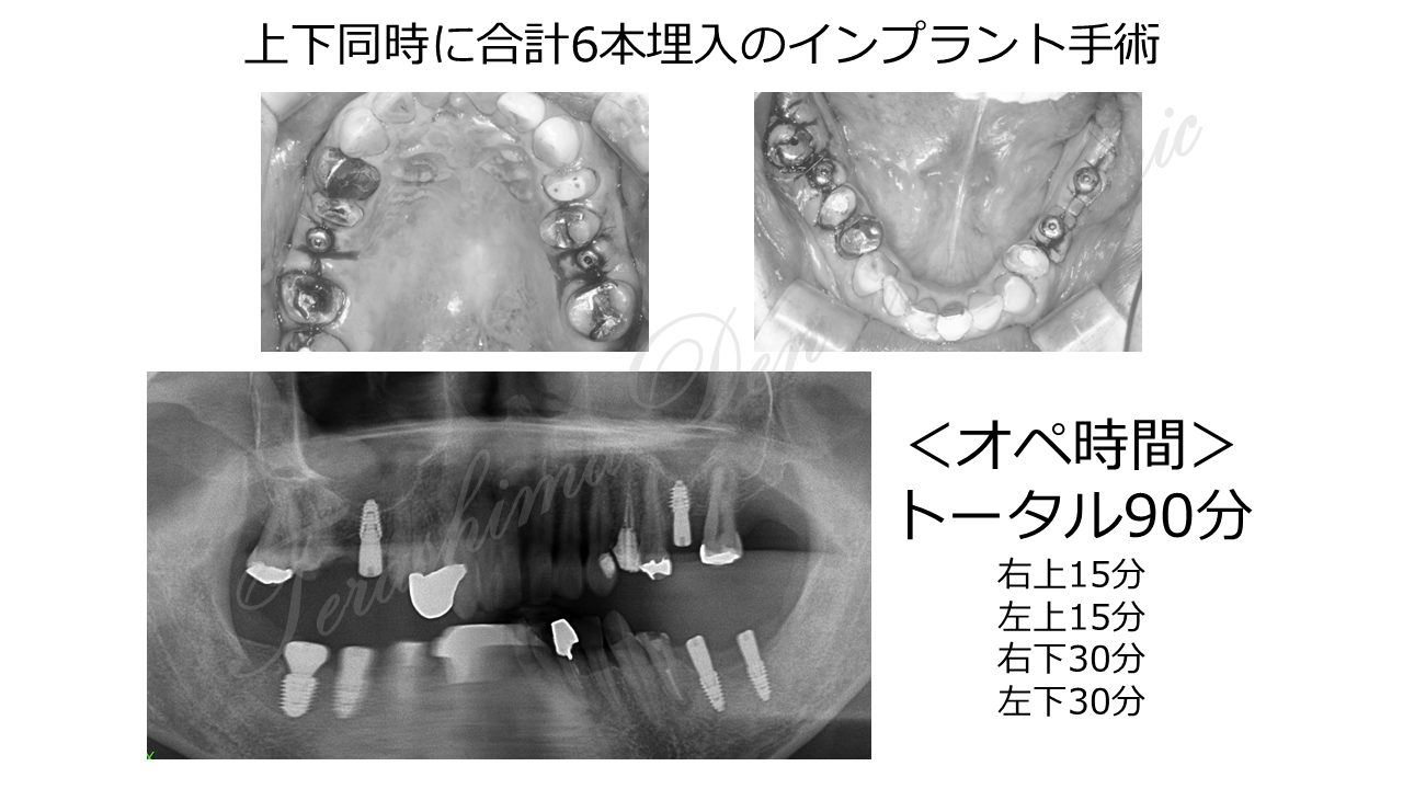 上下6本インプラントの全顎治療症例 | 箕面市の歯医者【寺嶋歯科医院