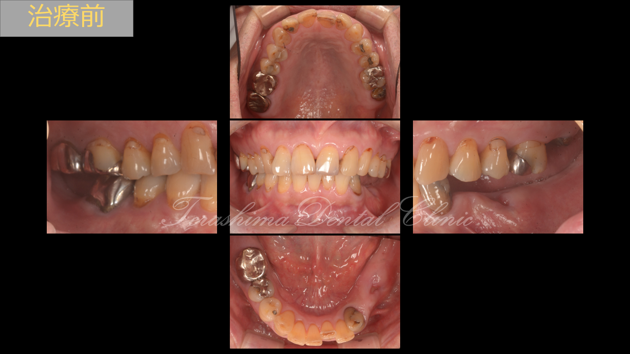シンプルなインプラントとセラミックの複合治療～60代男性～ | 箕面市